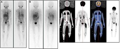 MIBG Therapy for Neuroblastoma: Precision Achieved With Dosimetry, and Concern for False Responders